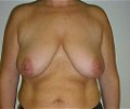 Frauenbusen vor einer Bruststraffung - Brustverkleinerung